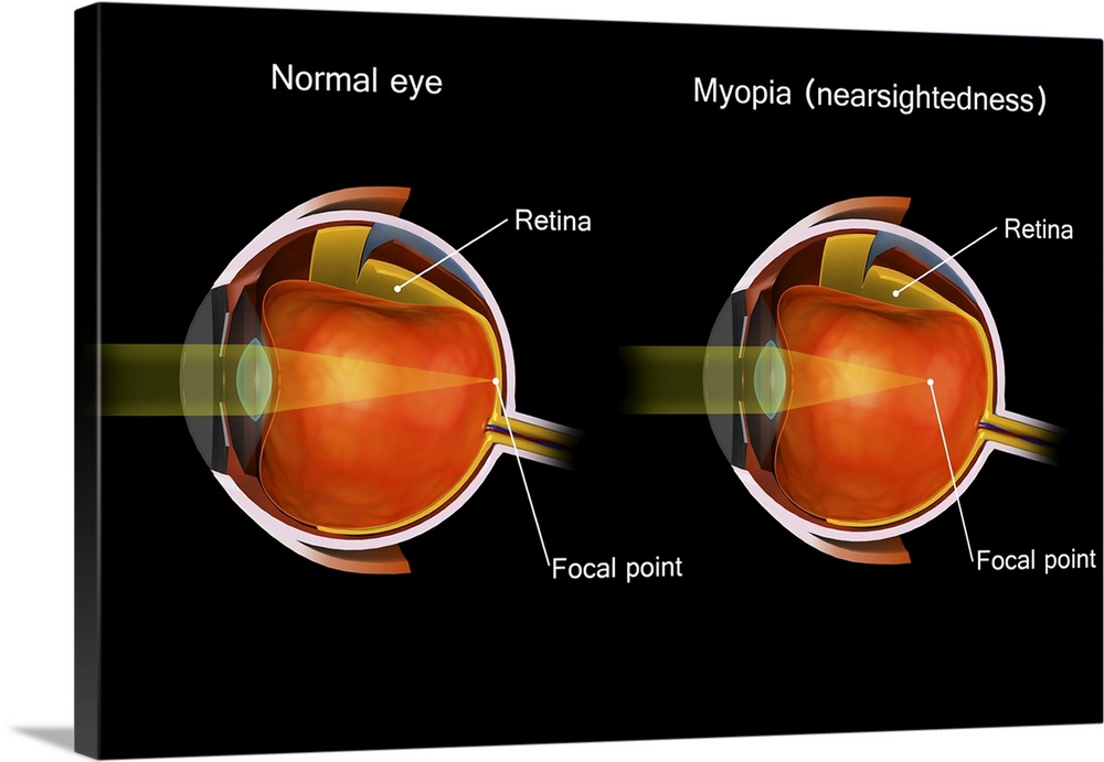 Comparison of a normal eye and an eye with myopia.