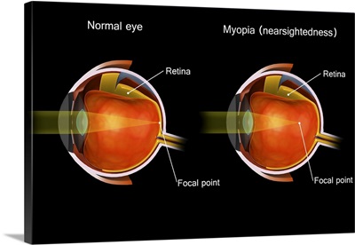 Comparison Of A Normal Eye And An Eye With Myopia