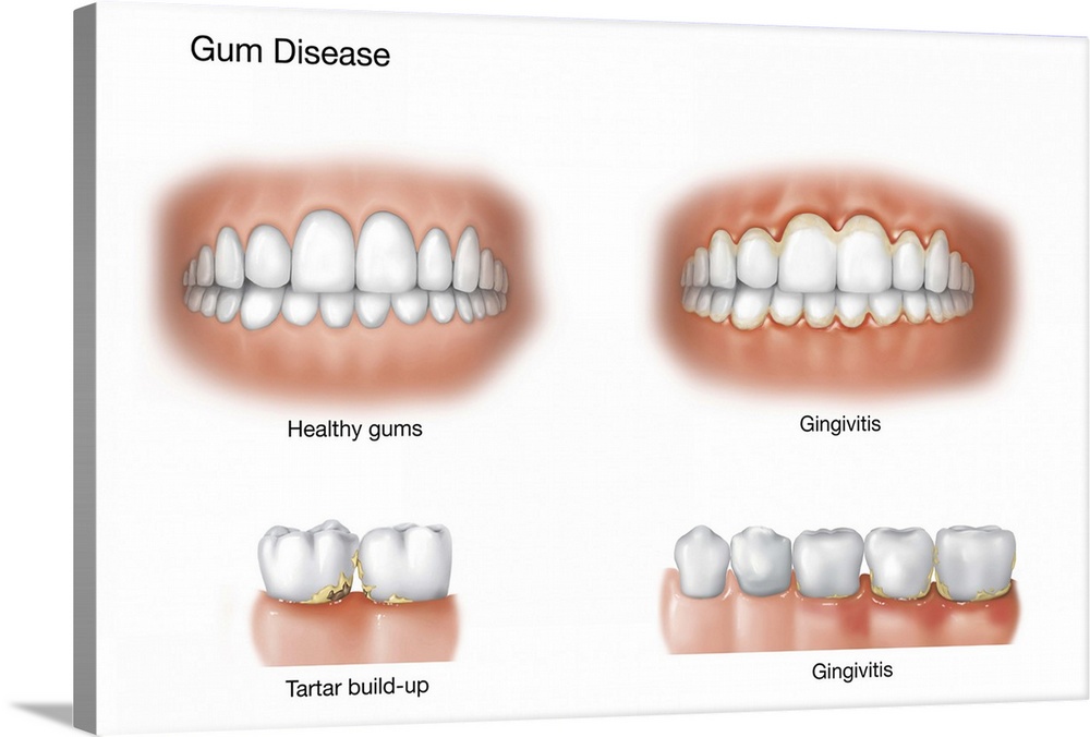 Comparison of healthy gums versus gingivitis.