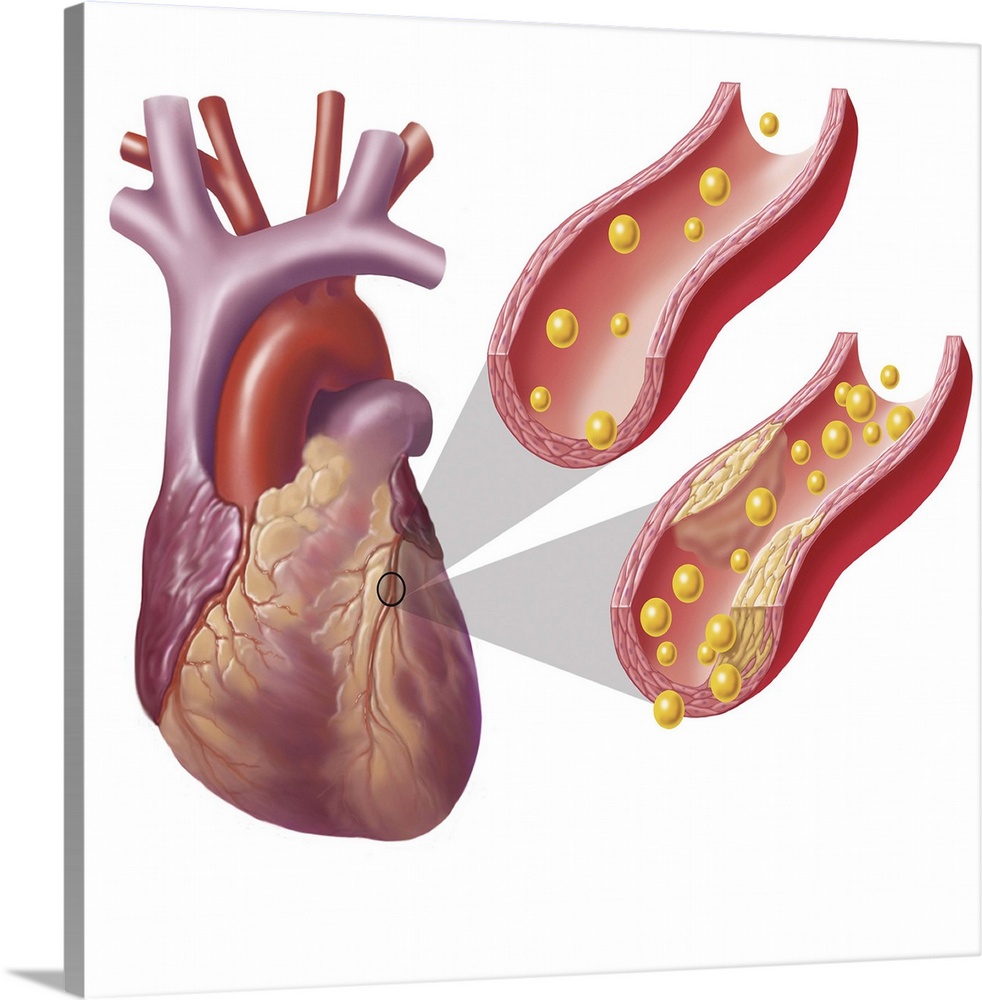 Heart with arteries showing cholesterol in one artery and atherosclerotic plaque in the other.