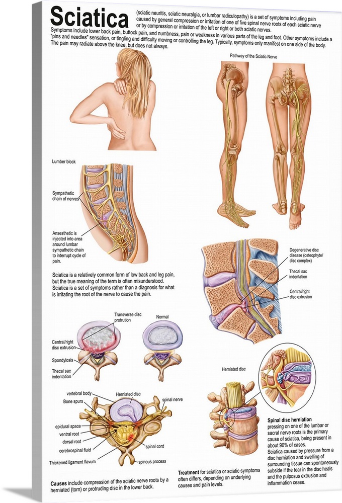 Medical chart showing the signs and symptoms of sciatica.