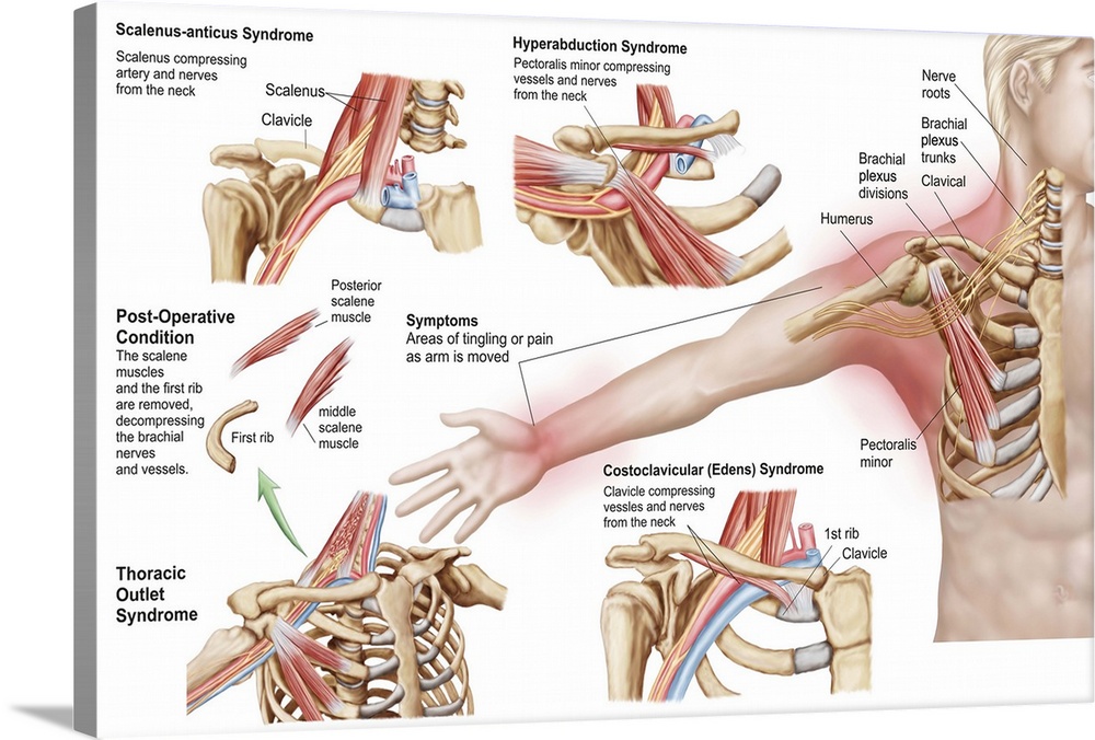 Medical illustration detailing thoracic outlet syndrome.