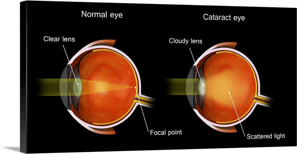 Medical illustration of a cataract in the human eye, compared to a normal eye.