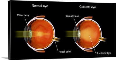 Medical Illustration Of A Cataract In The Human Eye, Compared To A Normal Eye