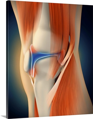 Medical illustration showing inflammation in human knee joint