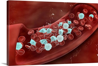 Microscopic view of blood clotting inside the artery