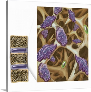 Osteoclasts eroding bone in osteoporosis image thumbnail