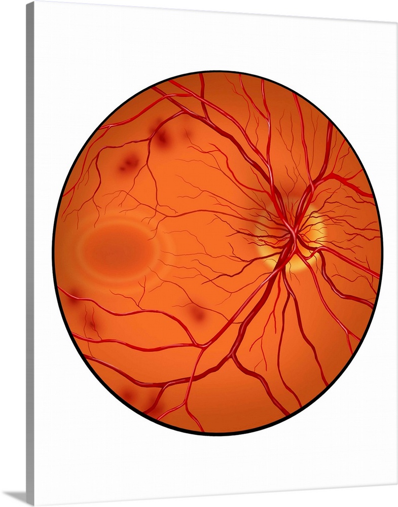 Retina with neovascularization showing retinal hemorrhaging.