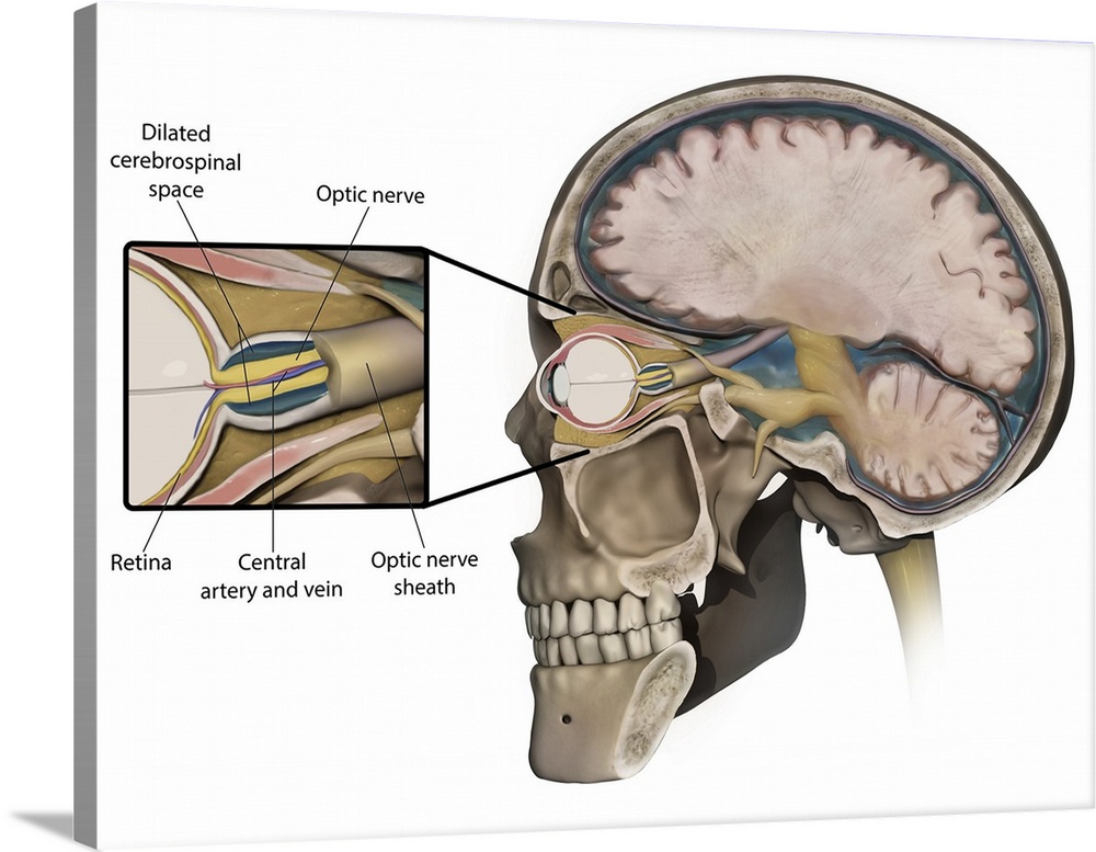 Medical concept shows swelling of the optic nerve caused by increased intracranial pressure.
