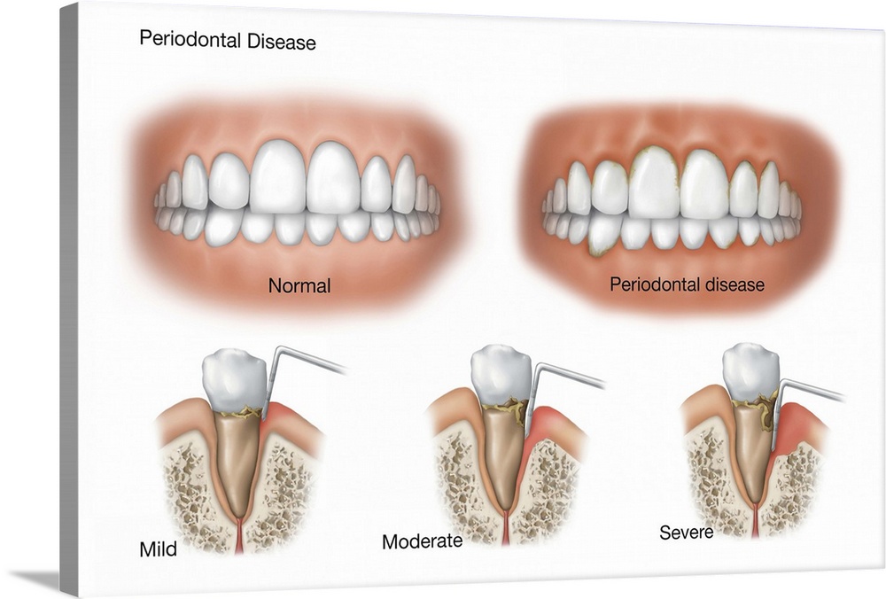 Three stages of periodontal disease.