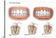 image thumbnail of Three stages of periodontal disease.